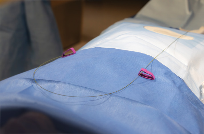 CaraClip easily curves to redirect the guidewire